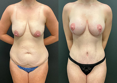 Front View breast lift with implants before and after photos by Cabbabe Plastic Surgery
