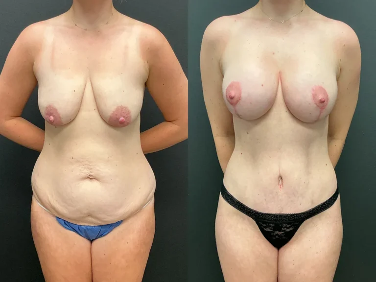 Front View breast lift with implants before and after photos by Cabbabe Plastic Surgery Front View breast lift with implants before and after photos by Cabbabe Plastic Surgery