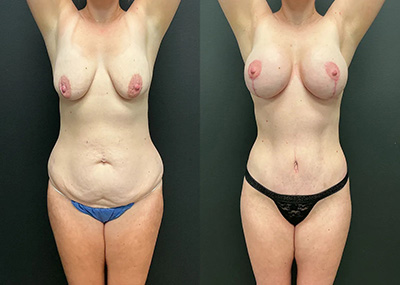 Front View lower body lift and mommy makeover before and after photos by Cabbabe Plastic Surgery