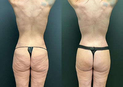 Back View triple and lower buttock lift and revision body contouring before and after photos by Cabbabe Plastic Surgery