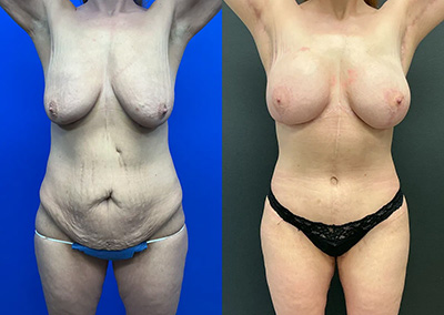 Front View Fleur de lis tummy tuck, lower body lift and medial thigh lift before and after photos by Cabbabe Plastic Surgery