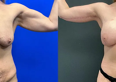 Front View arm lift before and after photos by Cabbabe Plastic Surgery