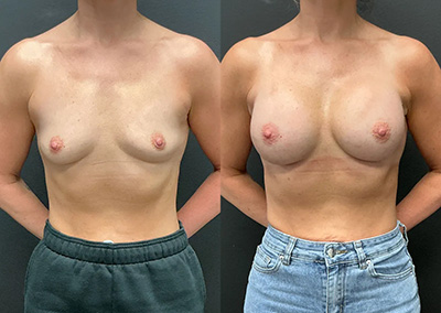 Front View breast augmentation before and after photos by Cabbabe Plastic Surgery