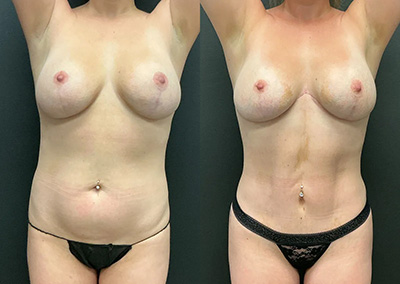 Front View dual tummy tuck before and after photos by Cabbabe Plastic Surgery