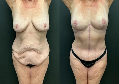 Front View fleur de lis before and after photos by Cabbabe Plastic Surgery