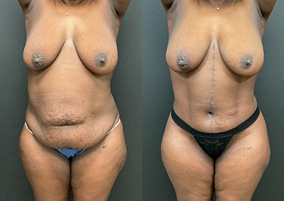 Front View fleur de lis tummy tuck before and after photos by Cabbabe Plastic Surgery
