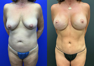 Front View mommy makeover and breast lift with implants before and after photos by Cabbabe Plastic Surgery