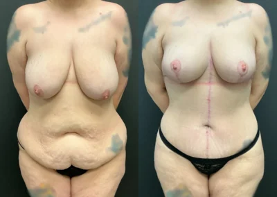 Front View body contouring, Fleur de lis and breast lift before and after photos by Cabbabe Plastic Surgery