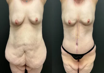 Front View plus size body contouring and Fleur de lis before and after photos by Cabbabe Plastic Surgery