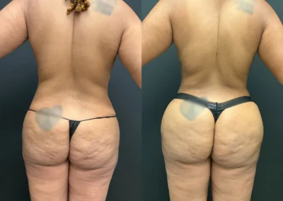 Back View BBL and reverse tummy tuck before and after photos by Cabbabe Plastic Surgery