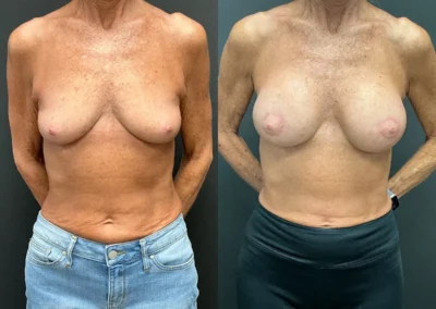 Front View Breast Augmentation before and after photos by Cabbabe Plastic Surgery